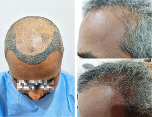 Hair Transplant Treatment yelahanka bangalore