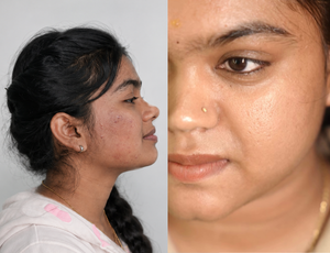  Microneedling Treatment yelahanka bangalore