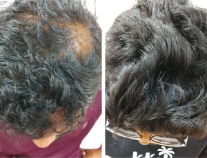 PRP Hair Treatment yelahanka bangalore
