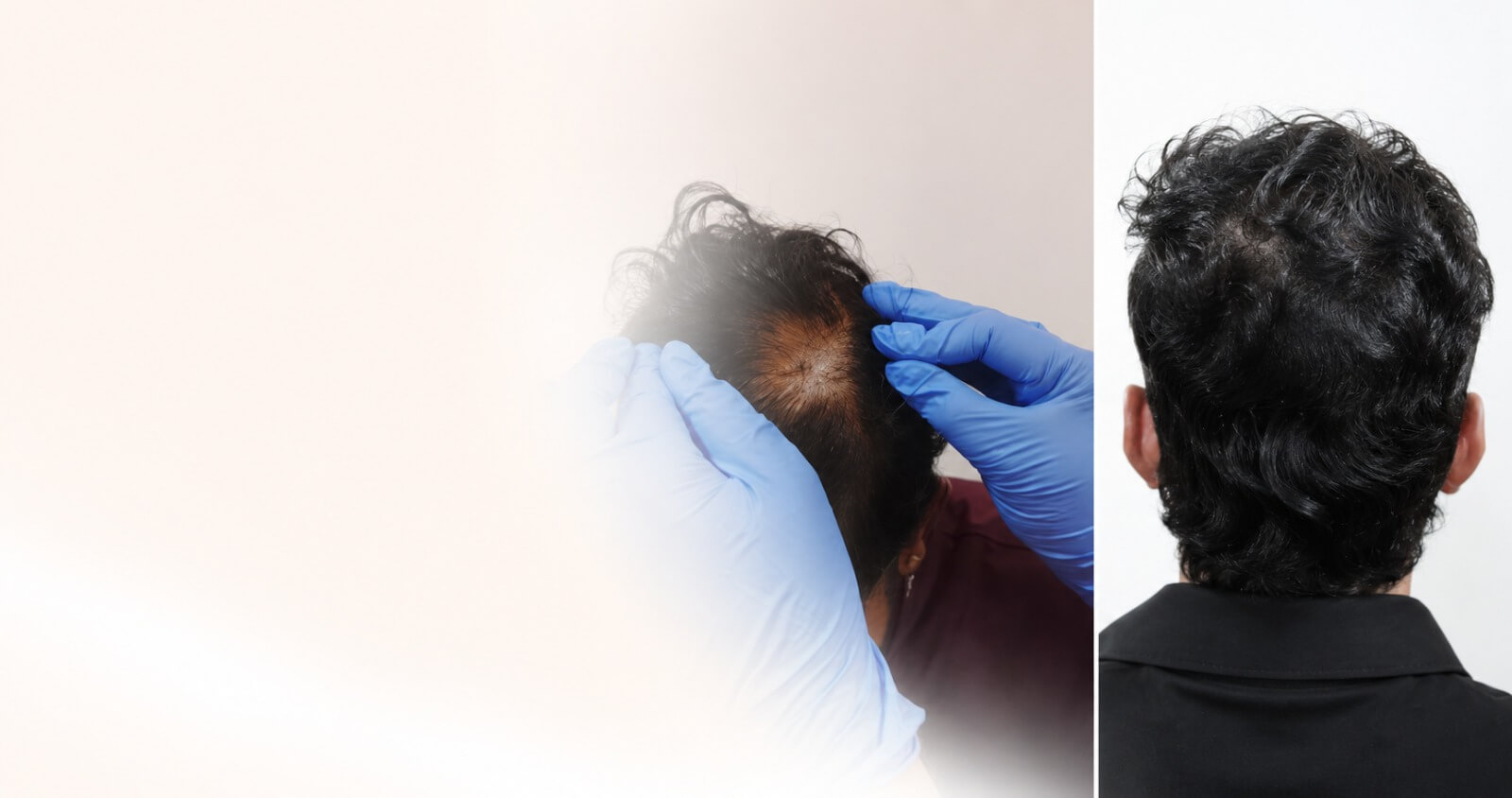 Hair Fall & Dandruff