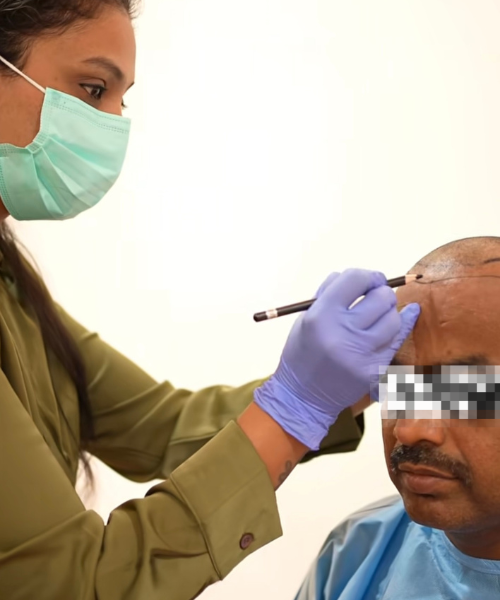 Hair transplant treatment in Yelahanka Bangalore at Perfect U Clinic for natural hair restoration