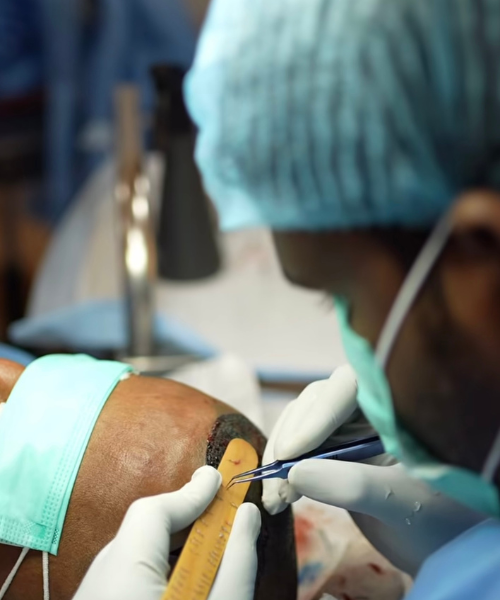 Safe hair transplant procedure in Yelahanka Bangalore performed by trained doctors in a sterile clinic environment