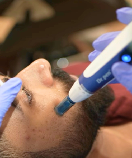 Hydrafacial treatment at Perfect U Clinic Bangalore