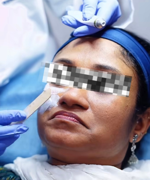 Chemical peel treatment at Perfect U Clinic Bangalore
